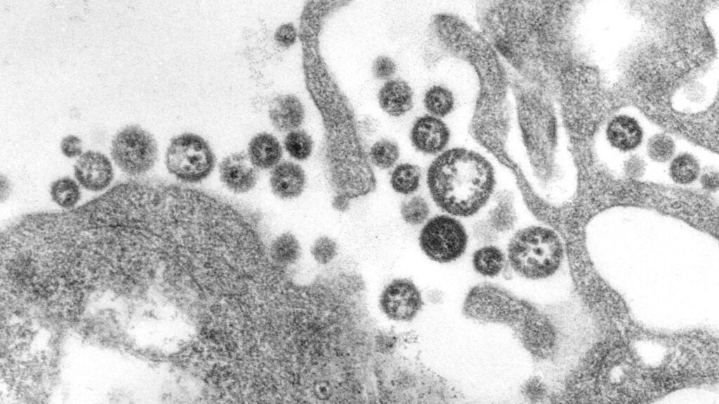 Iowa Resident Dies from Lassa Fever: Rare Virus Causes Hearing Loss