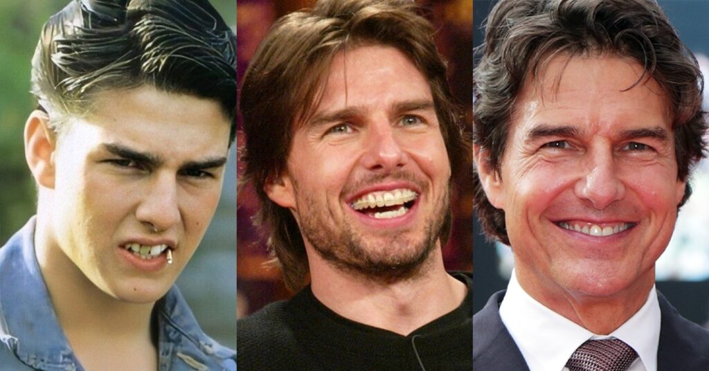 tom cruise teeth before and after