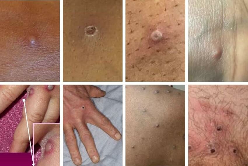 Mpox Virus in 2024: The Alarming Facts You Must Know Now!